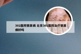 302医院银屑病 北京301医院治疗银屑病好吗