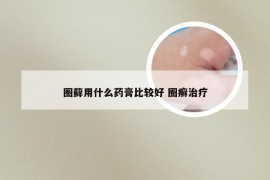 圈藓用什么药膏比较好 圈癣治疗