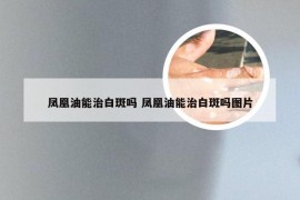 凤凰油能治白斑吗 凤凰油能治白斑吗图片