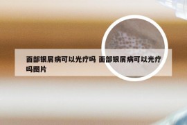 面部银屑病可以光疗吗 面部银屑病可以光疗吗图片