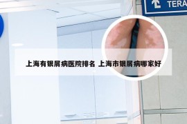 上海有银屑病医院排名 上海市银屑病哪家好