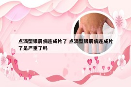 点滴型银屑病连成片了 点滴型银屑病连成片了是严重了吗