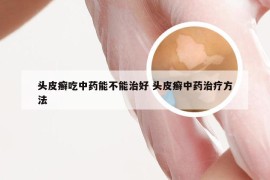 头皮癣吃中药能不能治好 头皮癣中药治疗方法