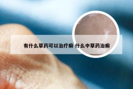 有什么草药可以治疗癣 什么中草药治癣