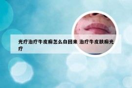 光疗治疗牛皮癣怎么白回来 治疗牛皮肤癣光疗