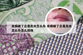 皮癣破了总是出水怎么办 皮癣破了总是出水怎么办怎么结痂