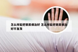 怎么样能把银屑病治好 怎么样能把银屑病治好不复发