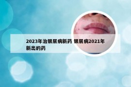 2023年治银屑病新药 银屑病2021年新出的药