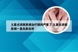 儿童点滴银屑病治疗期间严重了 儿童点滴银屑病一直出新皮疹