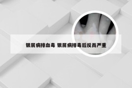 银屑病排血毒 银屑病排毒后反而严重