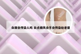 白颠会传染人吗 白点癫风会不会传染给老婆