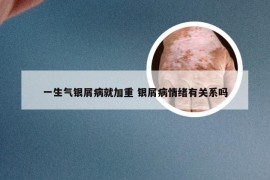 一生气银屑病就加重 银屑病情绪有关系吗