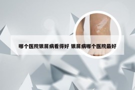 哪个医院银屑病看得好 银屑病哪个医院最好