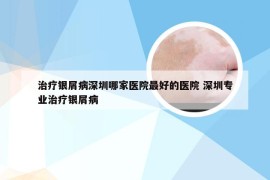 治疗银屑病深圳哪家医院最好的医院 深圳专业治疗银屑病