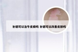 补硒可以治牛皮癣吗 补硒可以改善皮肤吗