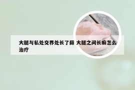 大腿与私处交界处长了藓 大腿之间长癣怎么治疗