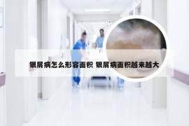 银屑病怎么形容面积 银屑病面积越来越大