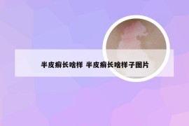 半皮癣长啥样 半皮癣长啥样子图片