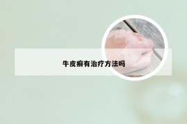 牛皮癣有治疗方法吗