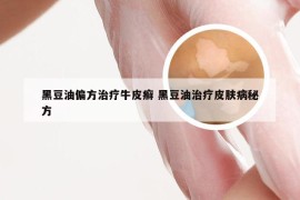 黑豆油偏方治疗牛皮癣 黑豆油治疗皮肤病秘方