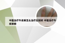 中医治疗牛皮癣怎么治疗比较好 中医治疗牛皮肤癣