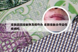 皮肤因因接触物发痒咋办 皮肤接触会传染性疾病吗