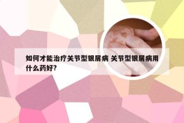 如何才能治疗关节型银屑病 关节型银屑病用什么药好?