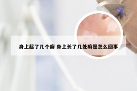 身上起了几个癣 身上长了几处癣是怎么回事