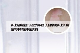 身上起癣是什么业力导致 人们常说身上长癣运气不好是不是真的