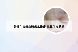 急性牛皮癣应该怎么治疗 急性牛皮肤癣