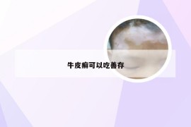 牛皮癣可以吃善存