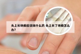 头上长块癣应该抹什么药 头上长了块癣怎么办?