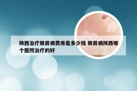 陕西治疗银屑病费用是多少钱 银屑病陕西哪个医院治疗的好