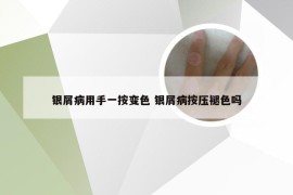 银屑病用手一按变色 银屑病按压褪色吗