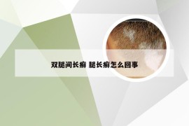 双腿间长癣 腿长癣怎么回事