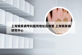 上海银屑病专科医院地址在哪里 上海银屑病研究中心