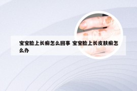 宝宝脸上长癣怎么回事 宝宝脸上长皮肤癣怎么办