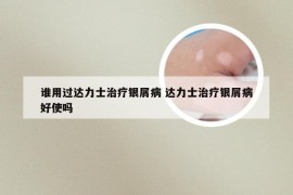 谁用过达力士治疗银屑病 达力士治疗银屑病好使吗