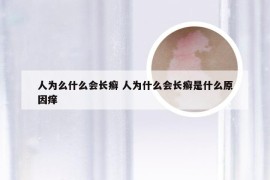 人为么什么会长癣 人为什么会长癣是什么原因痒