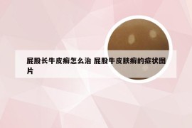 屁股长牛皮癣怎么治 屁股牛皮肤癣的症状图片