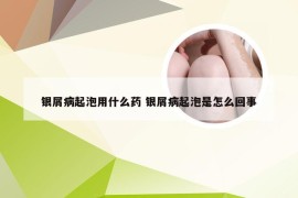 银屑病起泡用什么药 银屑病起泡是怎么回事