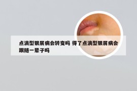 点滴型银屑病会转变吗 得了点滴型银屑病会跟随一辈子吗