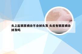 头上起银屑病会不会掉头发 头皮有银屑病会掉发吗