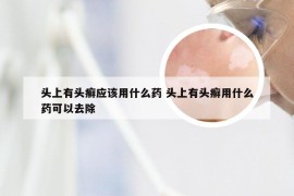 头上有头癣应该用什么药 头上有头癣用什么药可以去除