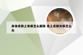 身体皮肤上有癣怎么解除 身上皮肤长癣怎么办