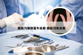 腹股沟瘙痒是牛皮癣 腹股沟有皮癣