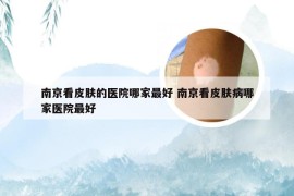 南京看皮肤的医院哪家最好 南京看皮肤病哪家医院最好