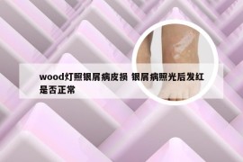 wood灯照银屑病皮损 银屑病照光后发红是否正常