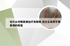 吃什么对银屑病治疗有帮助 吃什么有利于银屑病的恢复