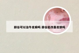 辟谷可以治牛皮癣吗 辟谷能改善皮肤吗